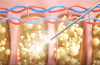 使用超音波共振方式,最大程度保留脂肪周圍組織 溫和溶脂技術-新竹音浪抽脂推薦