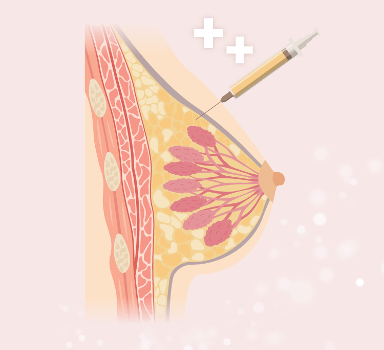 自體脂肪隆乳作用原理-新竹隆乳推薦