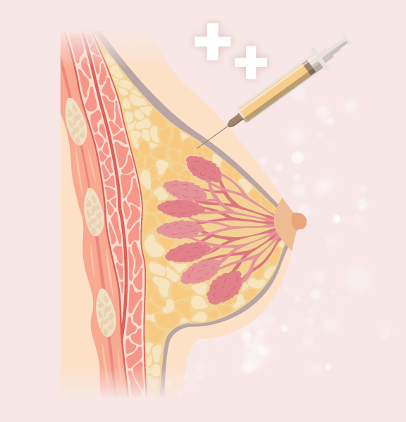 自體脂肪隆乳作用原理-新竹隆乳推薦