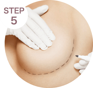 畫線標記-新竹隆乳推薦