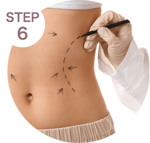 抽出脂肪-新竹隆乳推薦