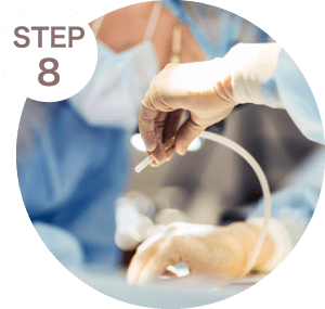 脂肪填充-新竹隆乳推薦