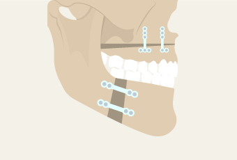 削骨固定-新竹削骨手術推薦