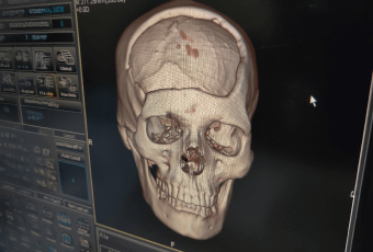 3D電腦斷層評估臉型-新竹削骨手術推薦