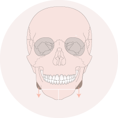 輪廓骨骼切除-新竹削骨手術