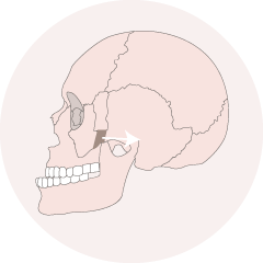 顴骨內推上削-新竹削骨手術