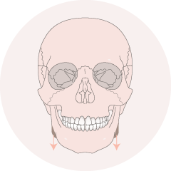 下顎骨削骨手術-新竹削骨手術推薦