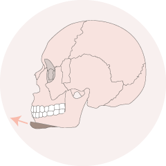 下巴截骨-新竹削骨手術