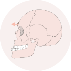 眉骨削骨手術-新竹削骨手術推薦