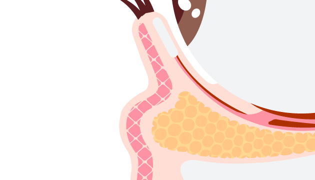 眼袋形成原因-新竹眼袋推薦