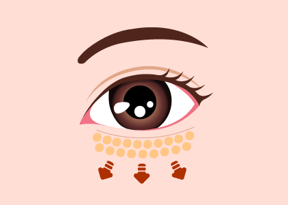 眼袋切除手術-新竹眼袋推薦