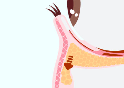 眼袋位移手術-新竹眼袋推薦