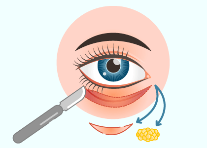 多合一眼袋手術-新竹眼袋推薦