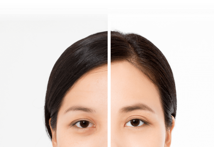 眼袋手術重點-新竹眼袋推薦