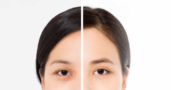 眼袋手術重點-新竹眼袋推薦