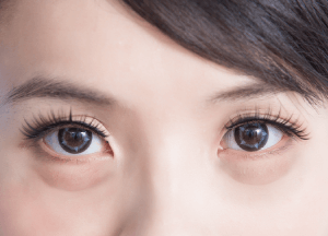 天生眼袋明顯-新竹眼袋推薦