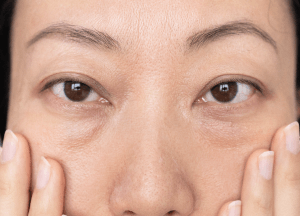 年紀漸長眼袋凸出-新竹眼袋推薦