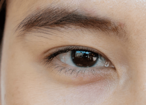 淚溝明顯-新竹眼袋推薦