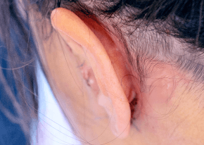 手術隱痕-新竹臉部拉皮手術