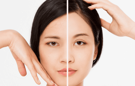 3合1提眉手術原理-新竹臉部拉皮手術推薦
