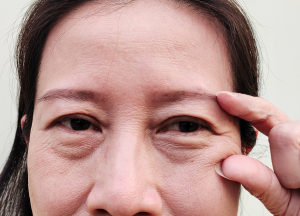 臉部疲倦-新竹臉部拉皮