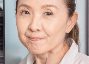 法令紋明顯-新竹臉部拉皮手術