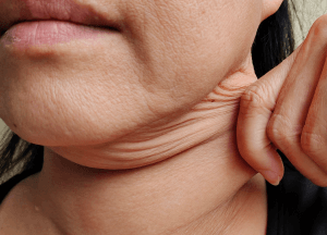 雙下巴-新竹臉部拉皮手術推薦