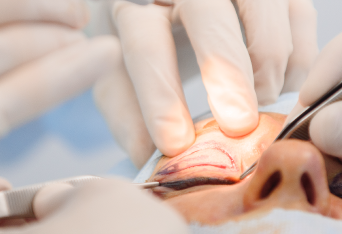 手術執行-新竹割雙眼皮推薦