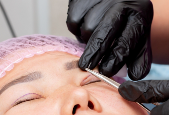 1週後拆線-新竹割雙眼皮推薦