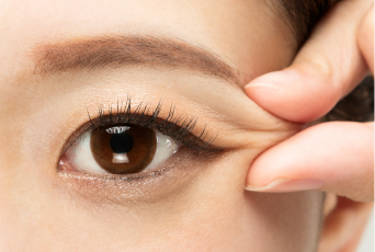 眼皮脂肪多者-新竹割雙眼皮推薦