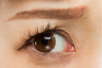 眼周皮膚下垂者-新竹割雙眼皮推薦