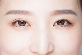 雙眼皮不對稱者-新竹割雙眼皮推薦