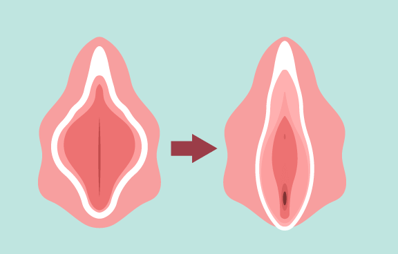 小陰唇縮小術-新竹私密處整形手術