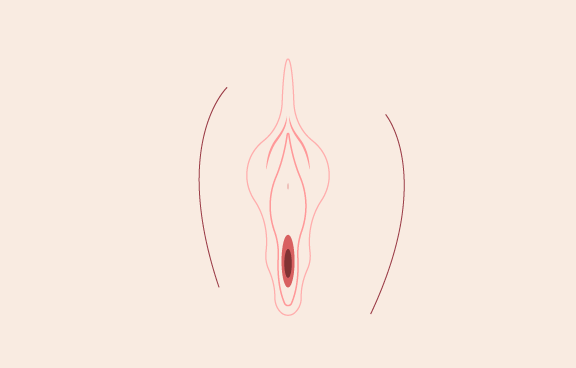 大/小陰唇複合修整-新竹私密處整形手術