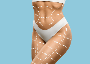 新竹抽脂推薦-新竹體雕推薦