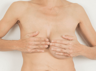 不滿意自身胸型-魔滴2.0隆乳-新竹隆乳推薦