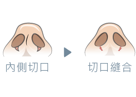 隱痕隆鼻-新竹隆鼻推薦