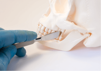 降低口腔疾病發生率-新竹正顎手術