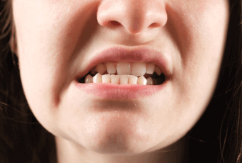 臉型不對稱-新竹正顎手術推薦