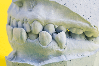 咬合不正-新竹正顎手術推薦