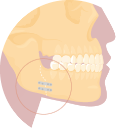 下顎骨矢劈開術-新竹正顎手術推薦