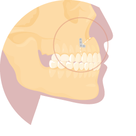 上顎前部切開術-新竹正顎手術推薦