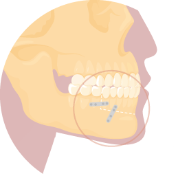 下顎前部切骨術-新竹正顎手術