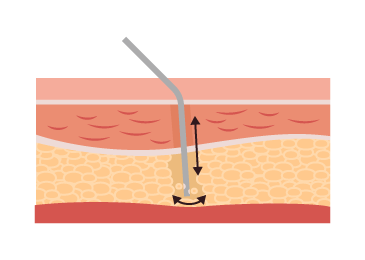 透過高速震動分離脂肪,保護組織不受過度破壞 移動脂肪保護組織-新竹竹北抽脂推薦