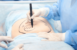 手術前做好標記、麻醉等事項,保障手術安全進行。 手術前置-新竹竹北抽脂推薦