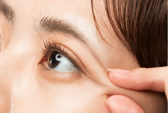 修復時間短-新竹縫雙眼皮推薦