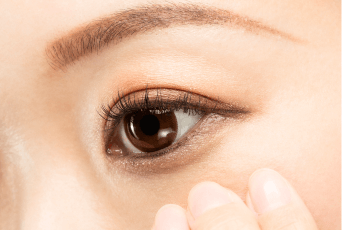 疤痕微小-新竹縫雙眼皮推薦