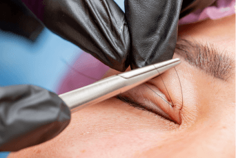 不須拆線-新竹縫雙眼皮推薦