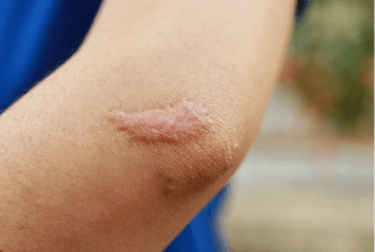 蟹足腫體質-新竹縫雙眼皮推薦