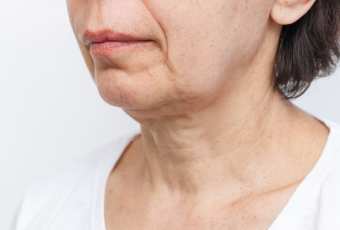 頸部皺紋-新竹天鵝頸手術推薦